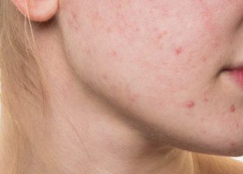 CAUSES & TREATMENT OF ADULT ACNE IN YOUR 30s