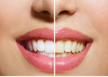 DIY TEETH BRIGHTEN TIPS TO FOLLOW BEFORE GETTING MARRIED